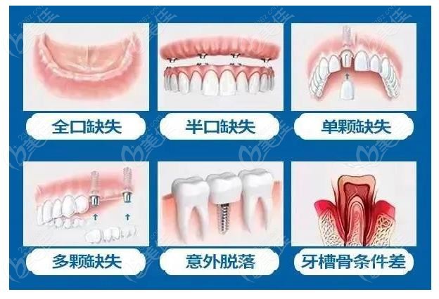 成都高德口腔种植牙怎么样