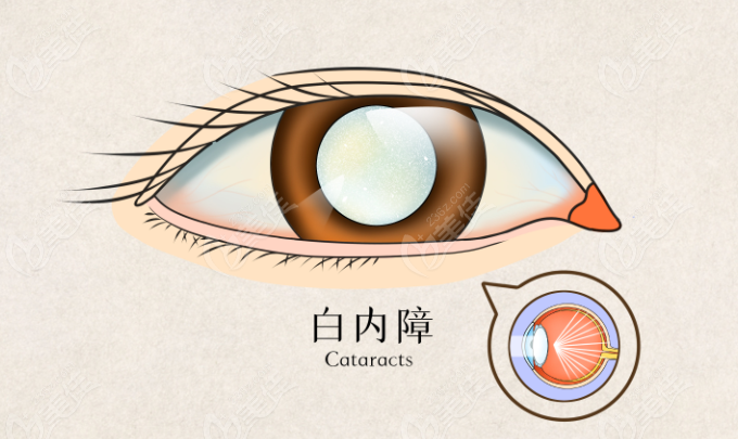 白内障示意图