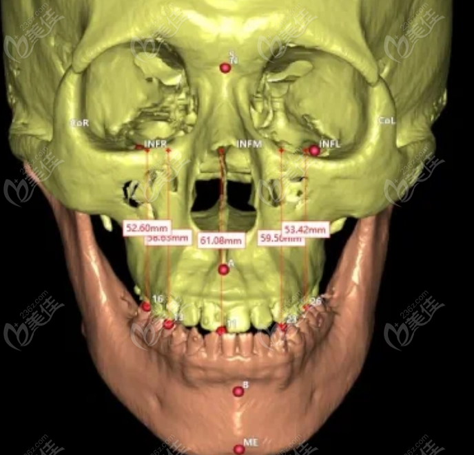 正颌手术改善嘴巴太突出侧面很丑的特点