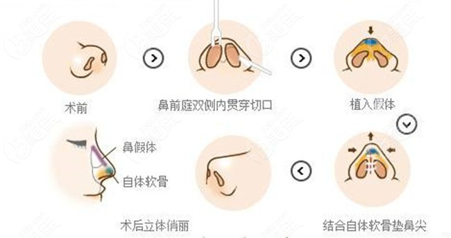 韩美整形做鼻子手术的技术优势