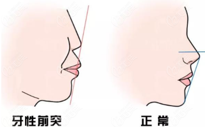 广州广大做骨性突嘴手术