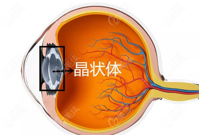 白内障手术后后囊浑浊属于手术问题吗？