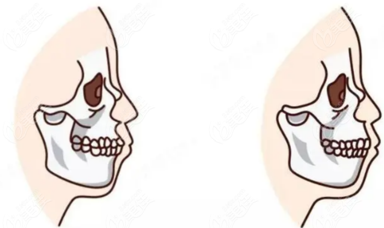 广州广大做骨性突嘴手术