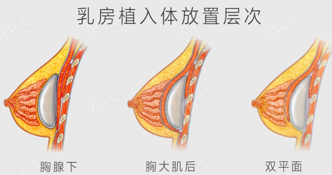 假体隆胸