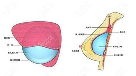 合肥维多利亚整形何贤清做胸技术图