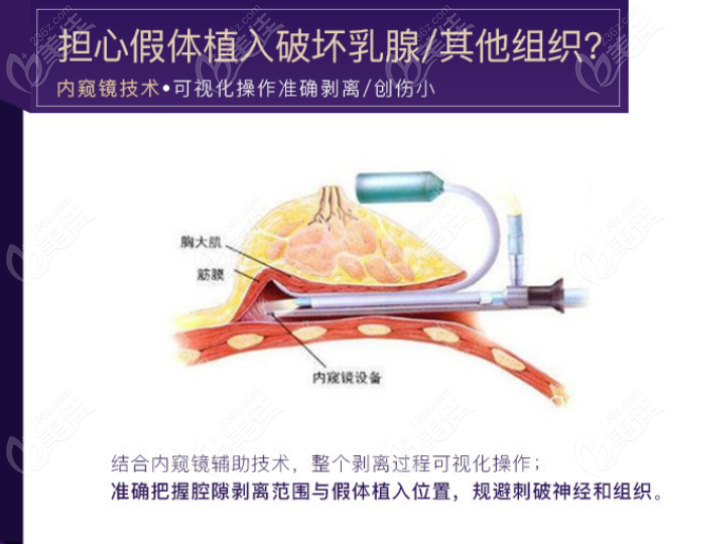 汪灏和夏建军隆胸哪个好