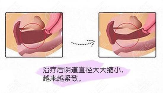 3d生物束带紧缩术做了三年了还能取出来吗