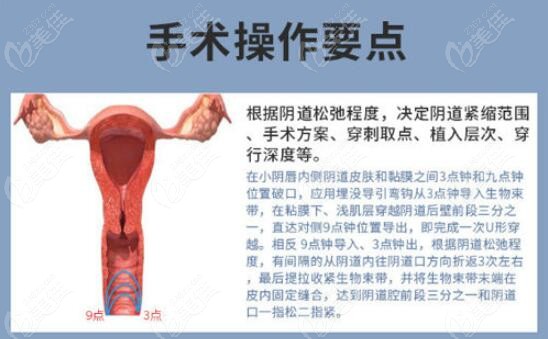 3d生物束带紧缩术是怎么做的m.