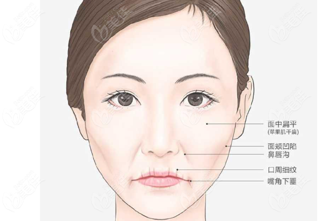 锚定韧带拉皮手术价格多少钱？贵吗？