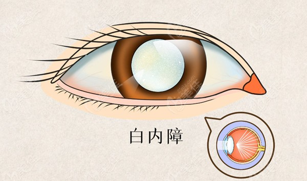 人工晶体悬吊术优势及适用人群