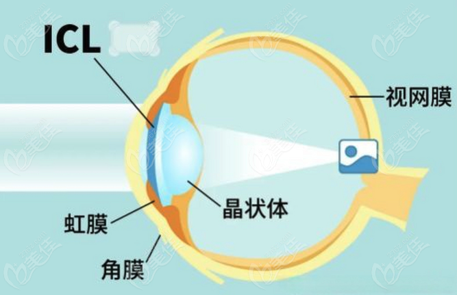 白内障晶体植入医院到底选哪家好呢