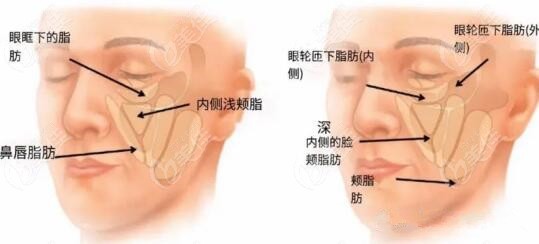 什么是筋膜悬吊和轮廓固定