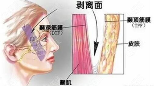 做筋膜悬吊和轮廓固定哪个好