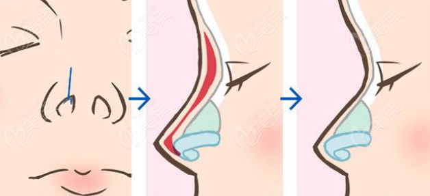 合肥艺星整形孙洋做鼻子的价格www236z.com