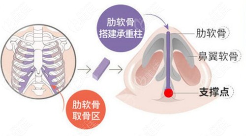 成都东篱整形李竞做鼻子技术图