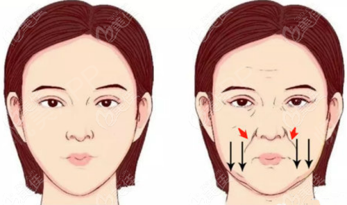 注射弗缦胶原蛋白填充法令纹对比www.236z.com