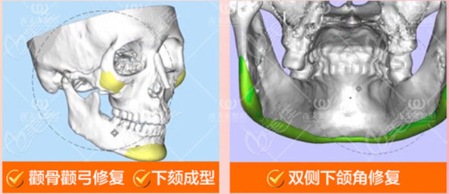 杭州连天美3d人工骨颌面修复技术强